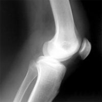 Exercise and TENS machine research for knee osteoarthritis